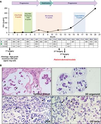 Case report: Preclinical efficacy of NEDD8 and proteasome inhibitors in patient-derived models of signet ring high-grade mucinous colorectal cancer from a Lynch syndrome patient